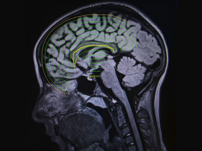 Brain scan